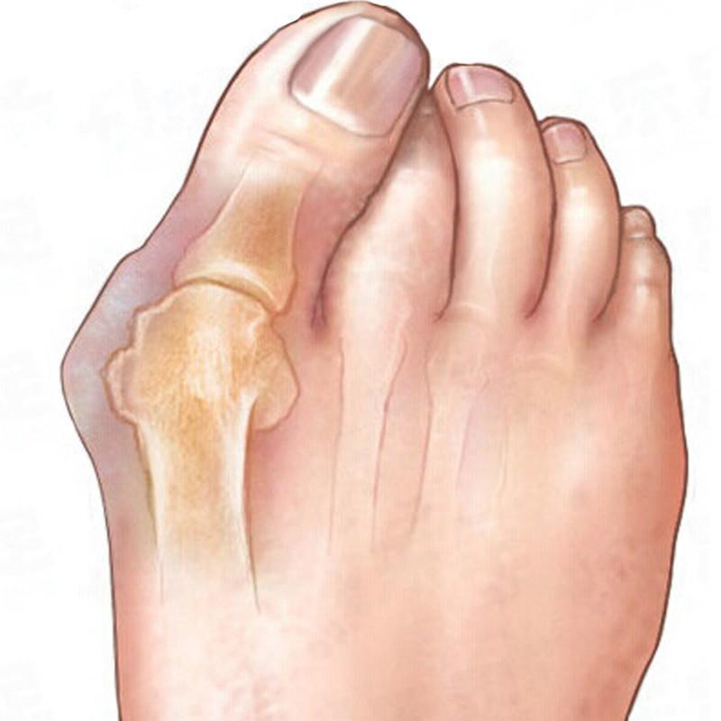 Gadgets d'Eve beauté Solacor™_ : Correcteur Orthopédique en  Gel de Silice