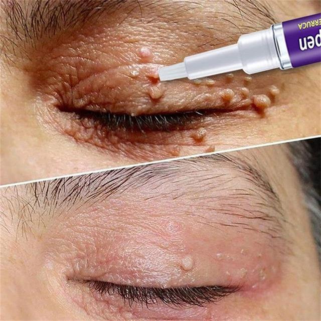 Gadgets d'Eve TAGFREE™ : Stylo Anti-Verrue